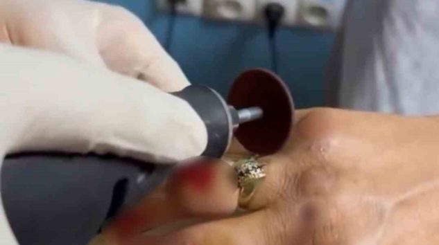 Yüzük, İtfaiye Ekipleri Tarafından Kesilerek Çıkarıldı